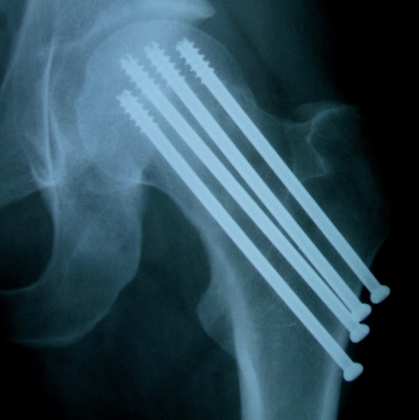 osso com 4 parafusos em chapa de raio x